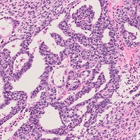 胚細胞腫瘍、混合型